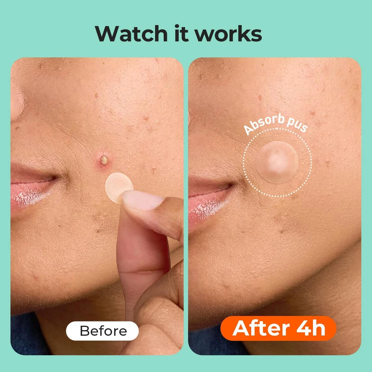 ZATKTK Pimple Patches