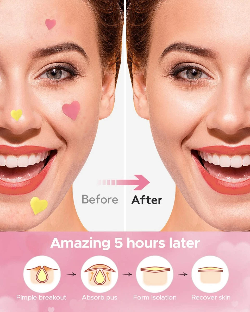LitBear 3 IN 1 Acne Patch